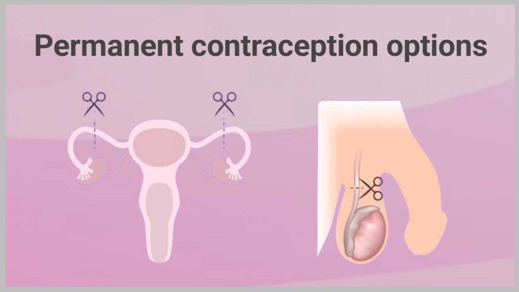 Permanent Contraception Options